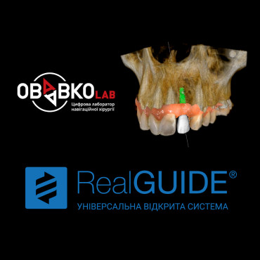 Цифровий протокол імплантологічного лікування.Огляд програмного забезпечення для планування імплантації Real Guide